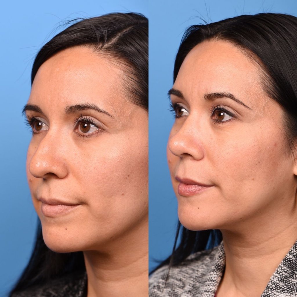 young female patient before and after rhinoplasty - left side