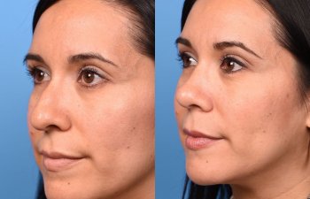 young female patient before and after rhinoplasty - left side