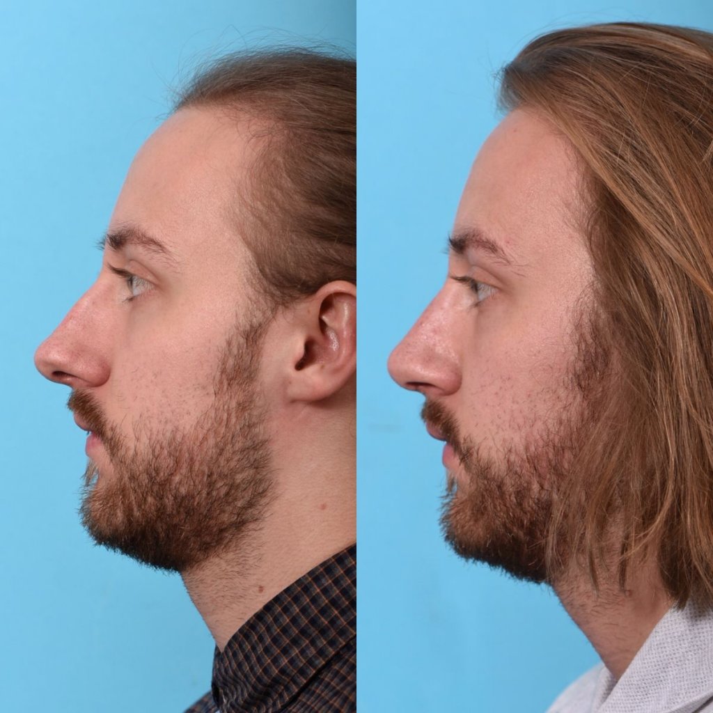 male patient before and after rhinoplasty - left side