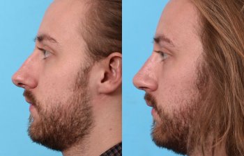 male patient before and after rhinoplasty - left side