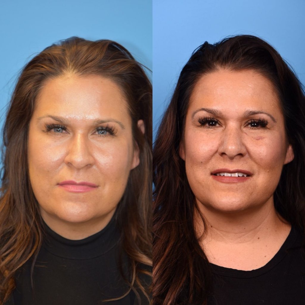 female patient before and after rhinoplasty - front