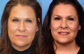 female patient before and after rhinoplasty - front