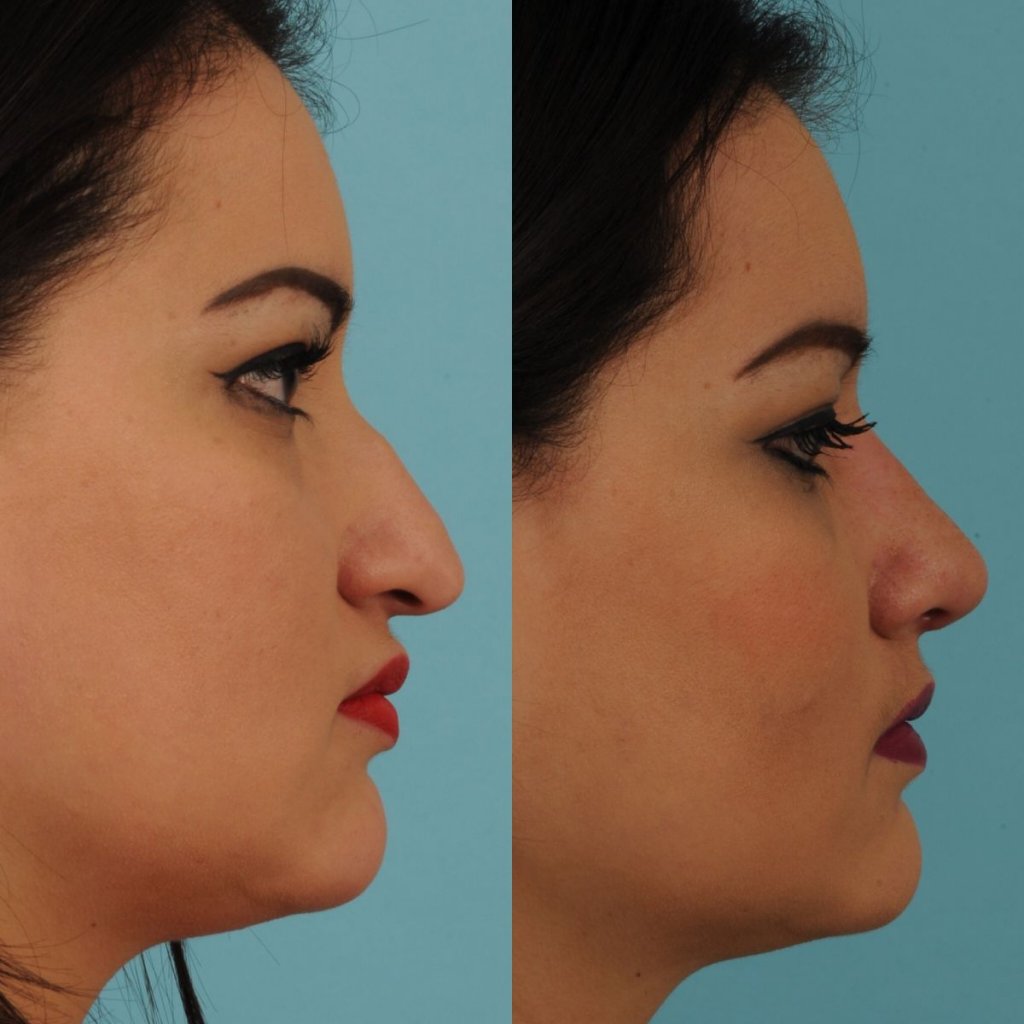 female patient before and after rhinoplasty - right side