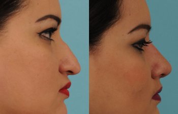 female patient before and after rhinoplasty - right side