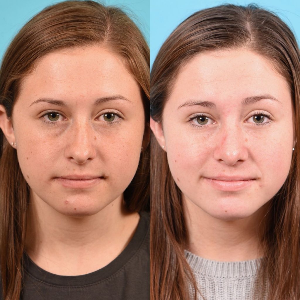 teenage girl before and after rhinoplasty - front