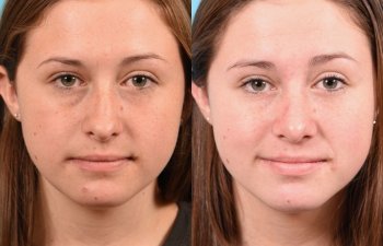 teenage girl before and after rhinoplasty - front