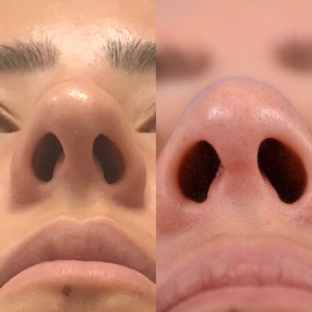 female patient before and after rhinoplasty - front