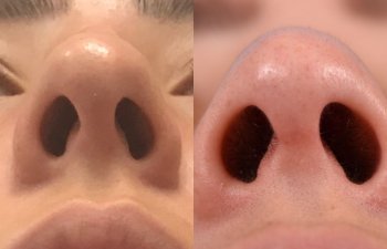 female patient before and after rhinoplasty - front