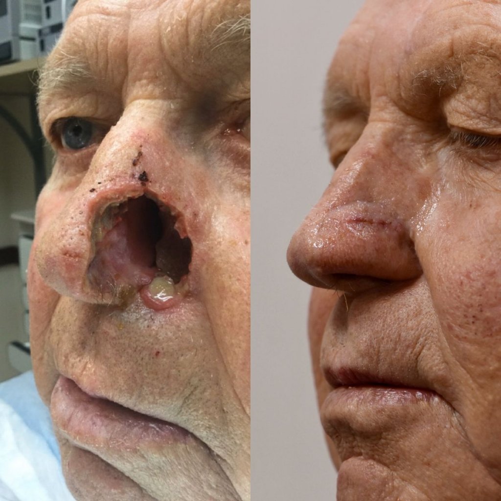 patient before and after nasal reconstructive surgery