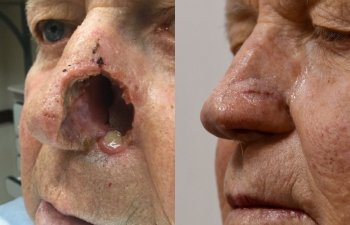 patient before and after nasal reconstructive surgery