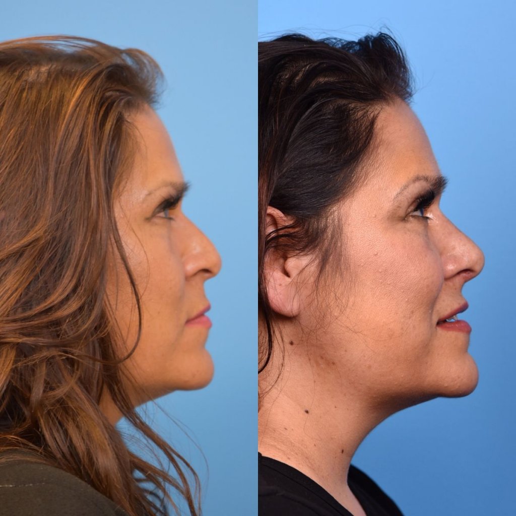 female patient before and after rhinoplasty - right side