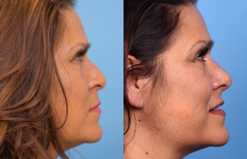 female patient before and after rhinoplasty - right side