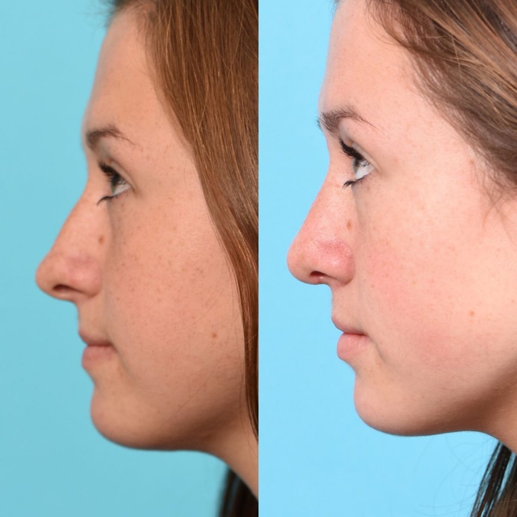 teenage girl before and after rhinoplasty - left side