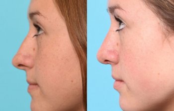 teenage girl before and after rhinoplasty - left side