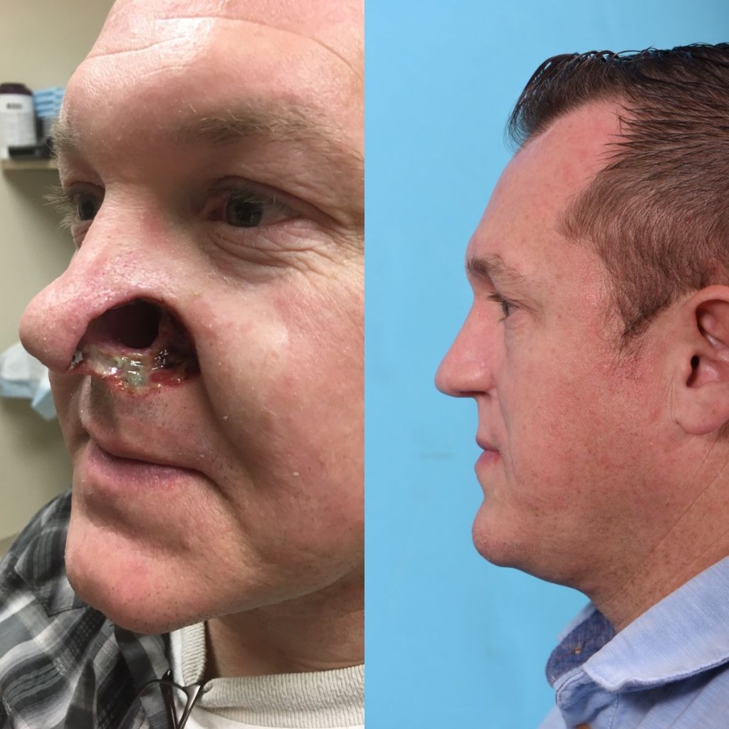 patient before and after nose reconstructive surgery