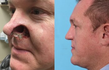 patient before and after nose reconstructive surgery