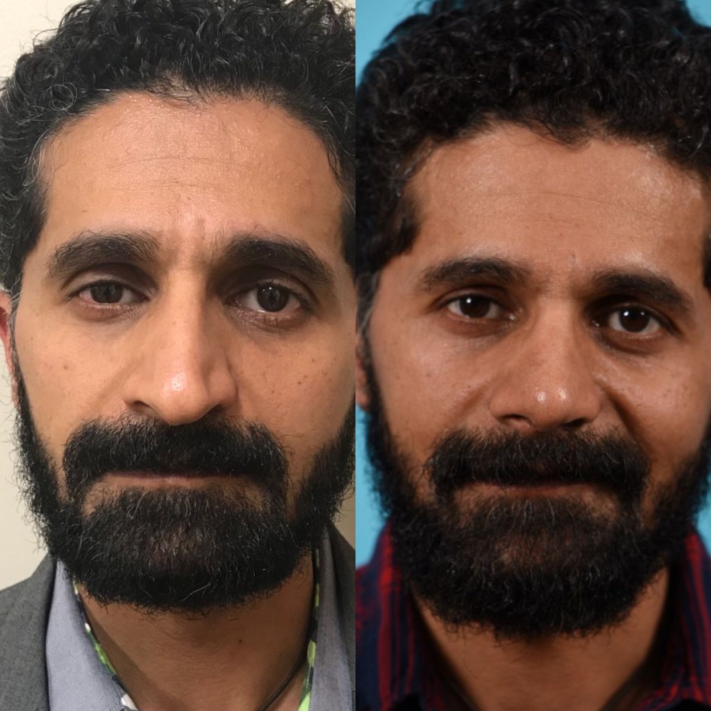 male patient before and after rhinoplasty - front