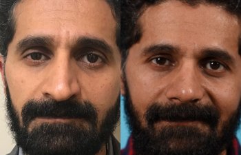 male patient before and after rhinoplasty - front