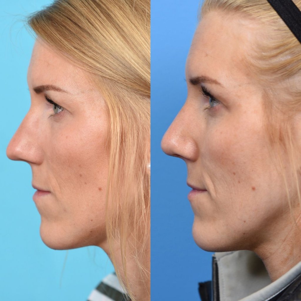 female patient before and after rhinoplasty - left side