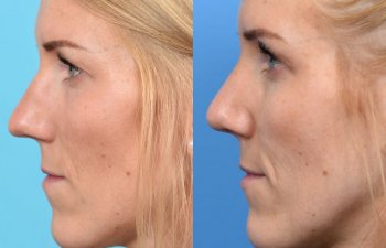 female patient before and after rhinoplasty - left side