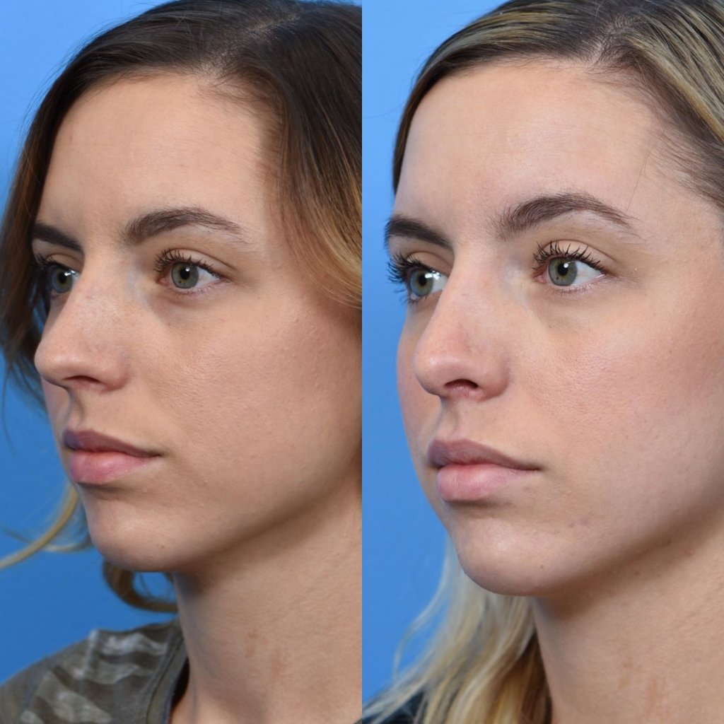 young female patient before and after rhinoplasty - left side