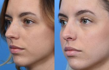 young female patient before and after rhinoplasty - left side