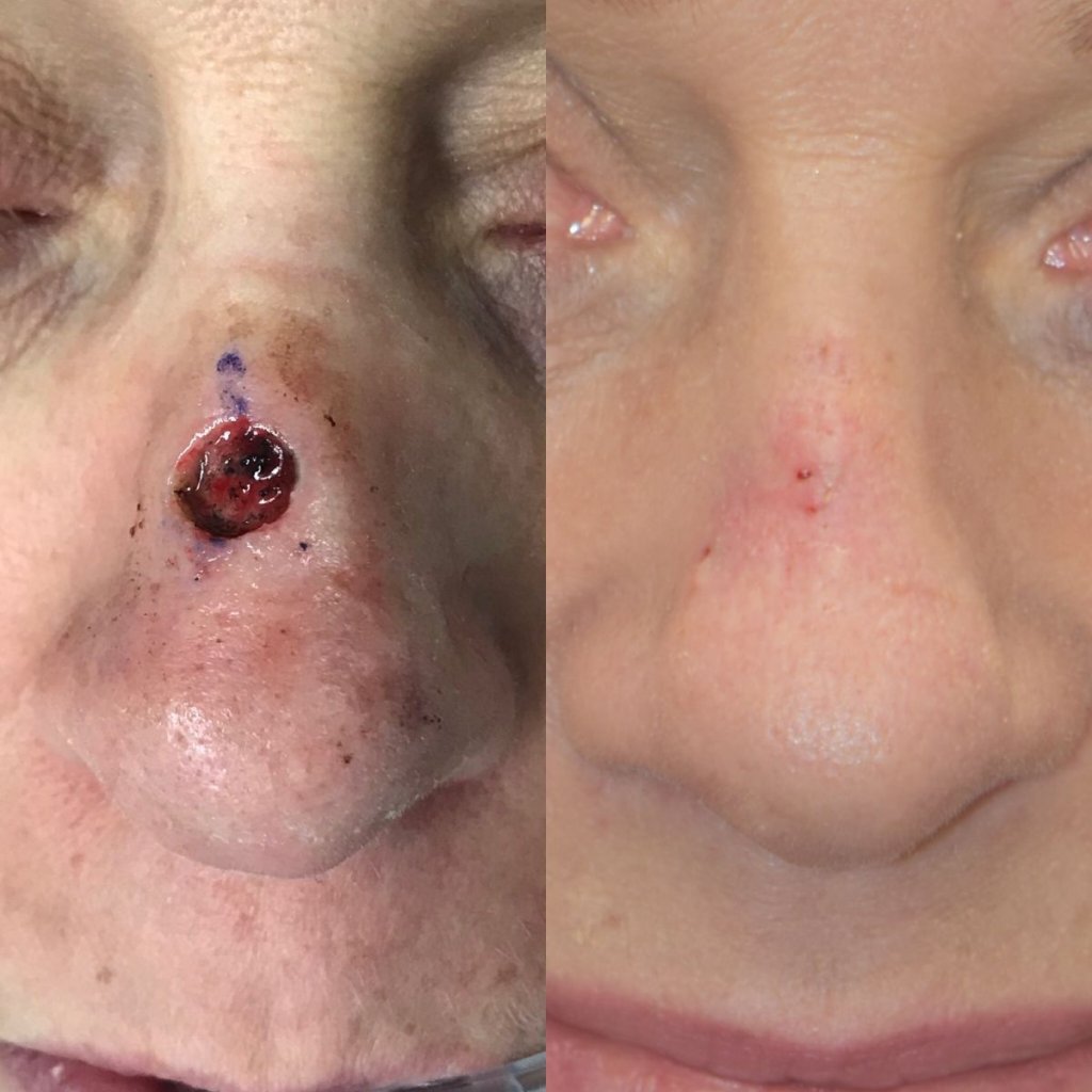 patient before and after nose MOHS reconstructive surgery