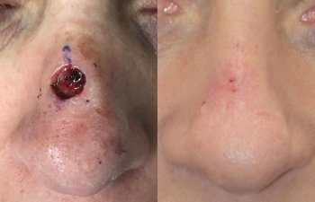patient before and after nose MOHS reconstructive surgery