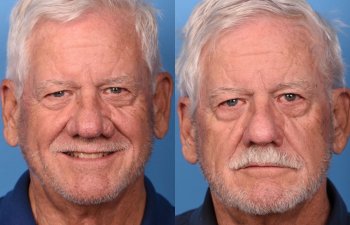 male patient before and after nasal reconstructive surgery