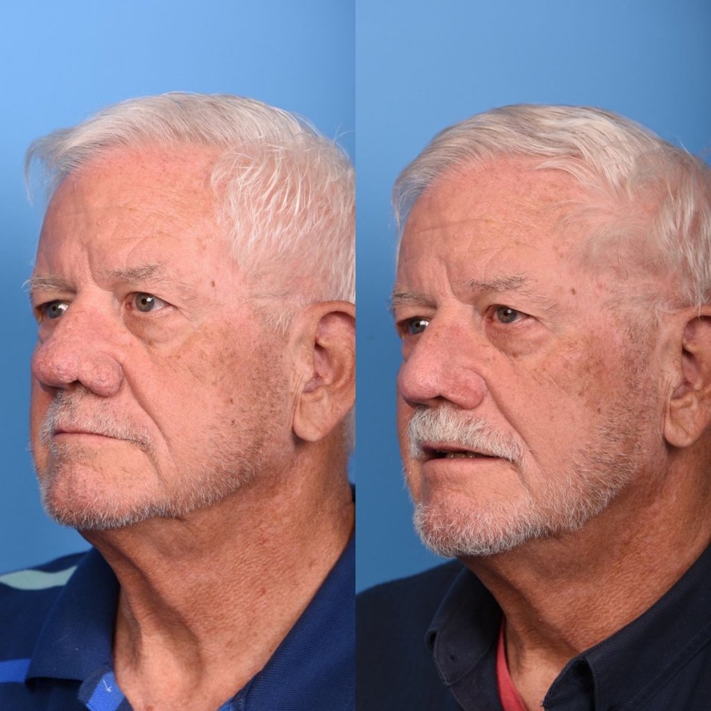 male patient before and after nasal reconstructive surgery