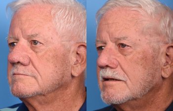 male patient before and after nasal reconstructive surgery