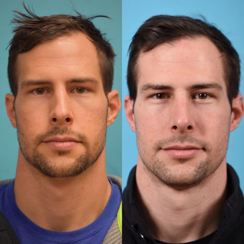 male patient before and after rhinoplasty - front