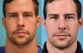 male patient before and after rhinoplasty - front