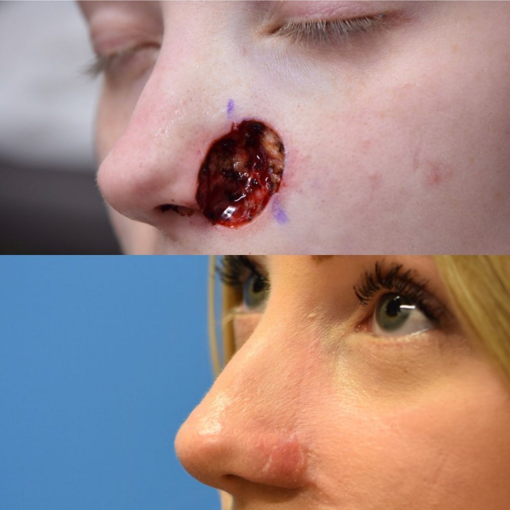 patient before and after nose MOHS reconstructive surgery