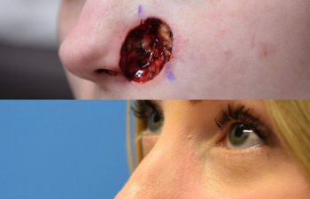 patient before and after nose MOHS reconstructive surgery