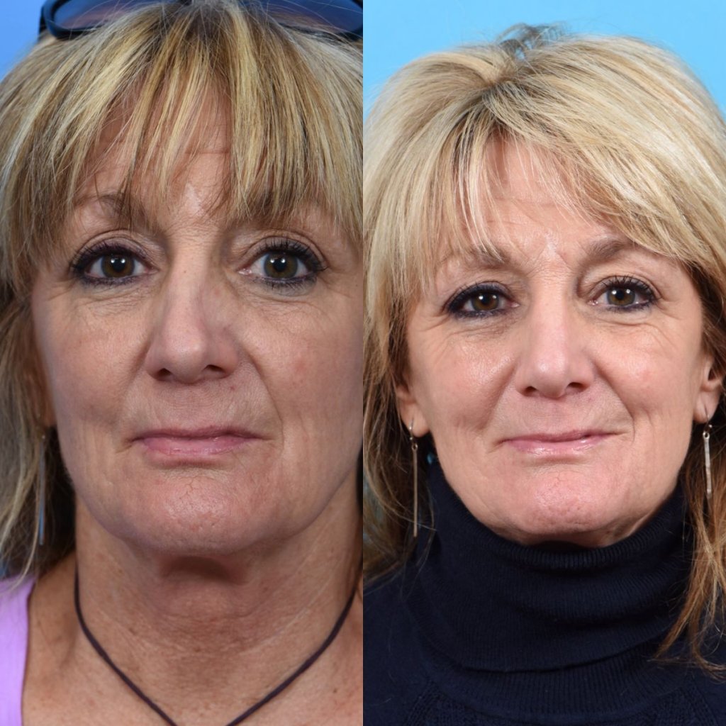 female patient before and after rhinoplasty - front