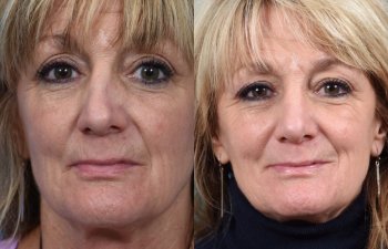 female patient before and after rhinoplasty - front