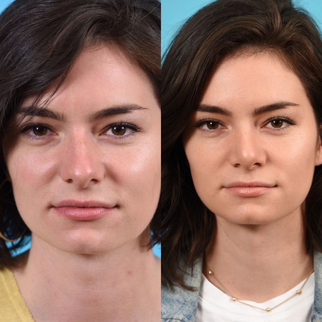 female patient before and after rhinoplasty - front