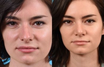 female patient before and after rhinoplasty - front