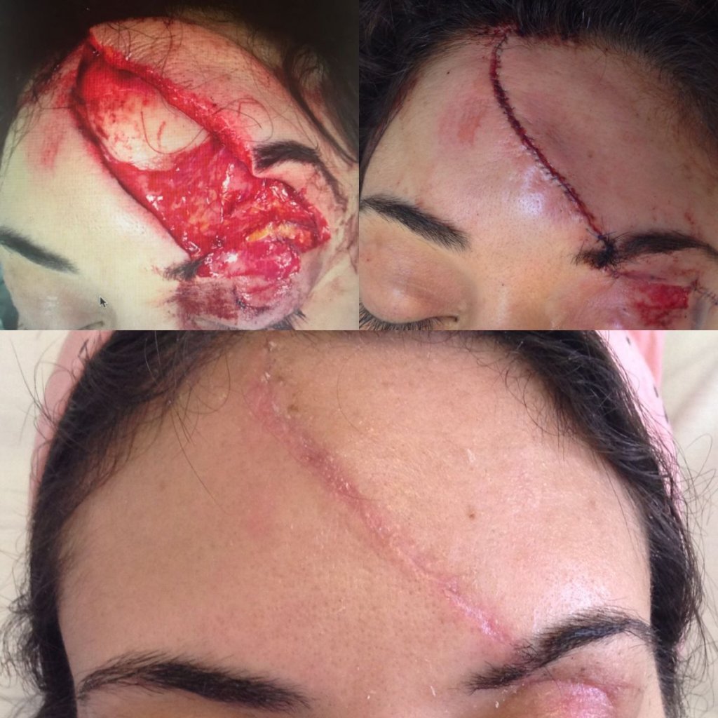 patient before and after forehead reconstructive surgery