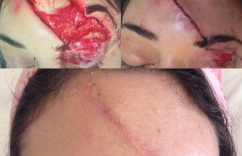 patient before and after forehead reconstructive surgery
