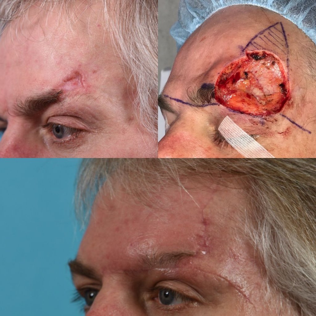 patient before and after forehead MOHS reconstructive surgery