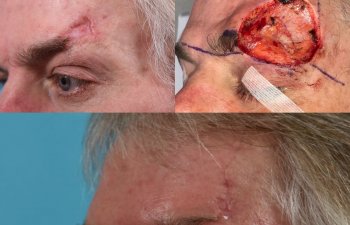 patient before and after forehead MOHS reconstructive surgery