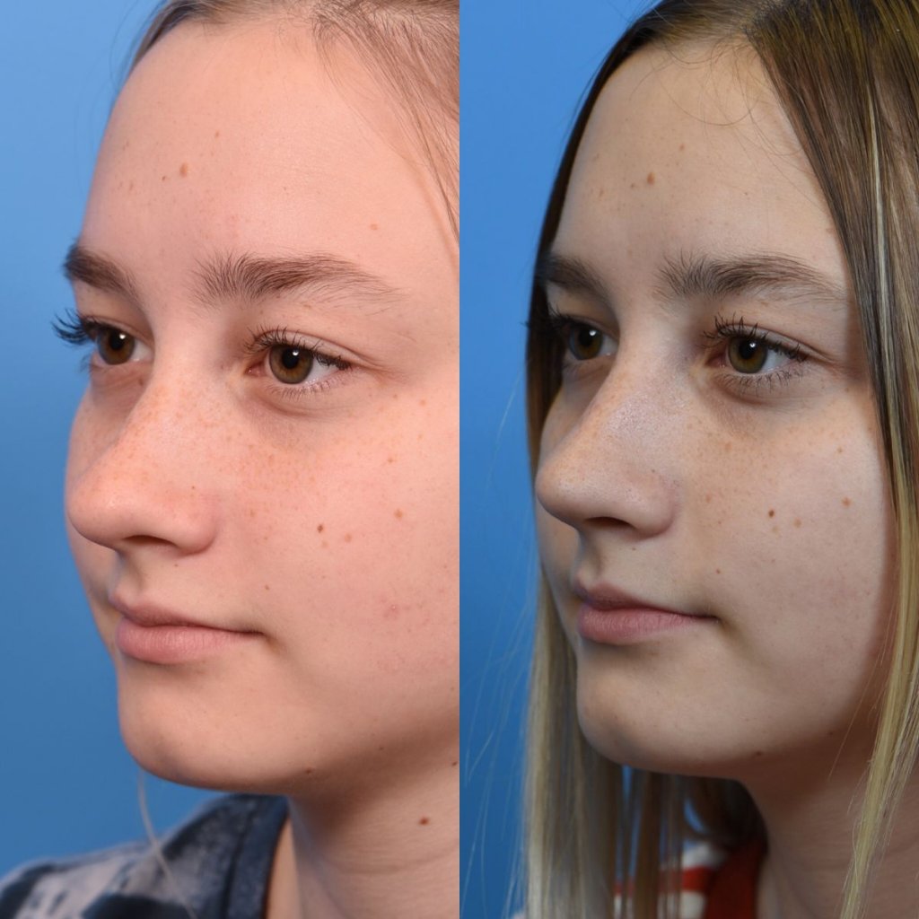 teenage girl before and after rhinoplasty - left side