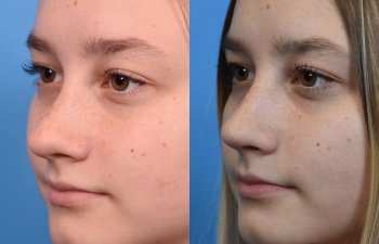 teenage girl before and after rhinoplasty - left side