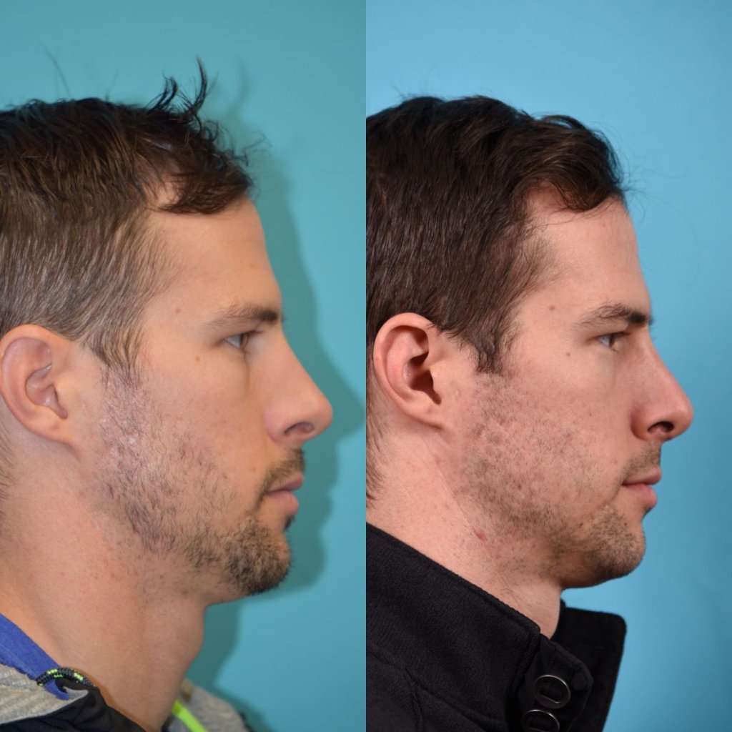 male patient before and after rhinoplasty - right side