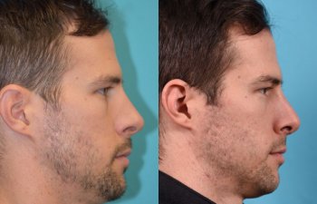 male patient before and after rhinoplasty - right side