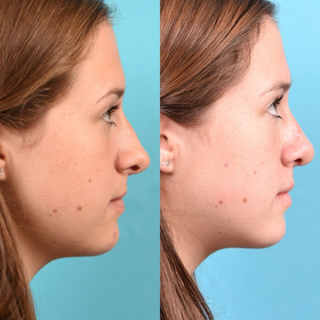teenage girl before and after rhinoplasty - right side