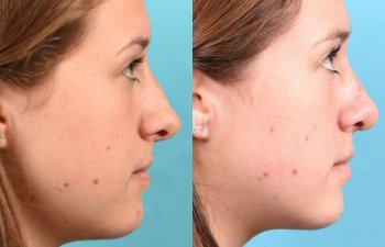 teenage girl before and after rhinoplasty - right side