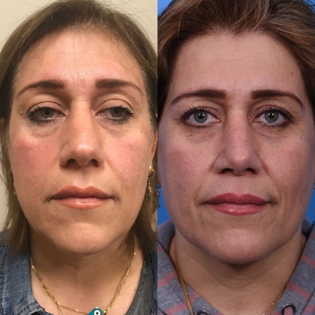 female patient before and after rhinoplasty - front